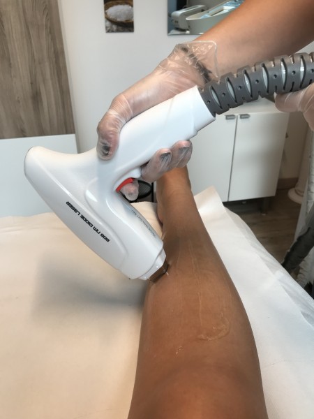 épilation au laser